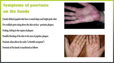 Psoriasis on the hands and palms | Psoriasis expert