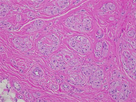 Granular Cell Tumor Histology