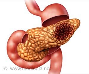 Insulinoma - Causes, Symptoms, Risk Factors, Complications, Diagnosis ...