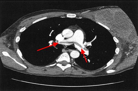 Pulmonary Embolism - Causes, Signs & Symptoms, Diagnosis, Treatment