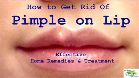 How to Get Rid of a Pimple on Lip?: Best 9 Remedies and Treatments