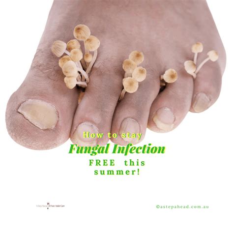 How To Get Rid Of Stinky Fungus Feet at melissadfpowell blog