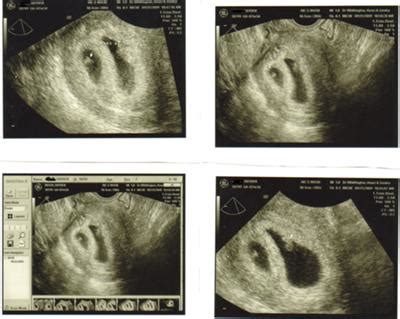 Twins at 6 Weeks: What's Like in Ultrasound Pictures? - New Kids Center