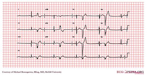 Premature Ventricular Contraction Ventrikular Ekstrasistol Ina Ecg | My ...