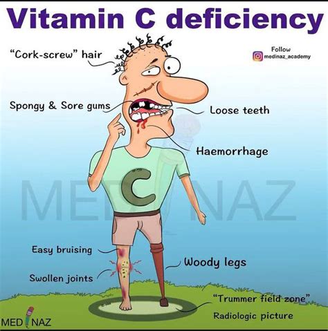 Vitamin C Deficiency - MEDizzy