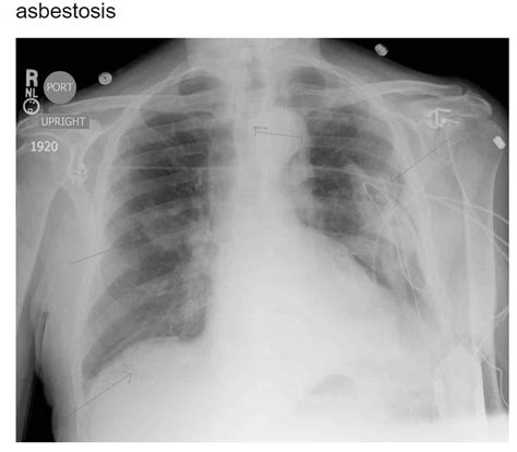 Mysterious White Lung Syndrome IS NOT MYSTERIOUS