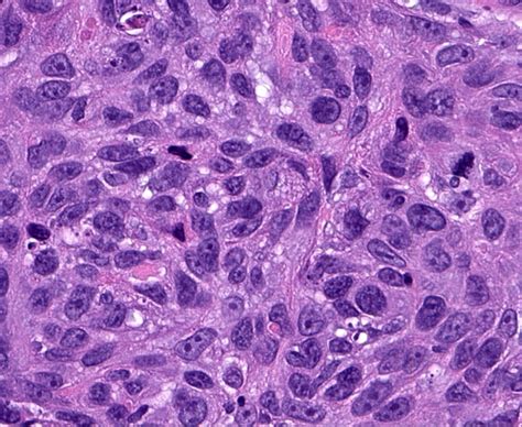 Squamous Cell Carcinoma Histology