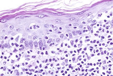 Cutaneous T-Cell Lymphoma Incidence on the Rise in the United States ...