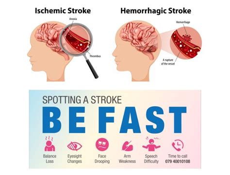 Neurosurgery in Brain Stroke Treatment by HCG Hospitals