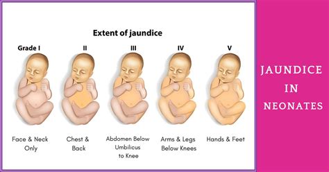 Neonatal Jaundice Babies