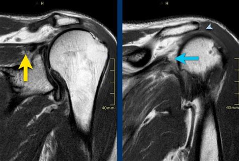 Supraspinatus Tear Mri