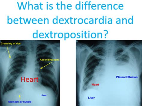 What is the difference between dextrocardia and dextroposition? – All About Heart And Blood Vessels