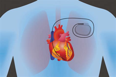 Pacemaker Implant | Dr. Benny Jose