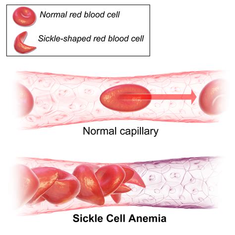 CRISPR gene editing corrects sickle cells in a mouse – NextBigFuture.com