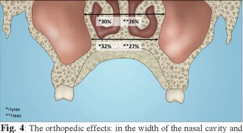 Figure 1 from Tomographic evaluation of dentoskeletal effects of rapid maxillary expansion using ...