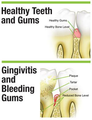 What Causes Bleeding Gums | Gum Disease & Gingivitis Effects