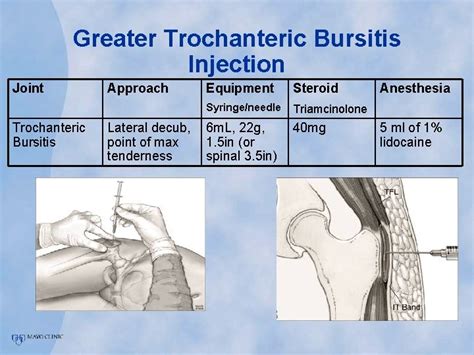 Trochanteric Bursitis Injection Technique