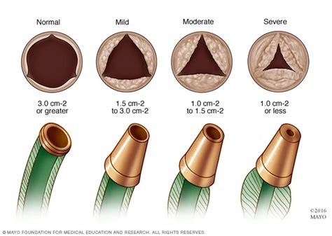 Aortic valve disease - Symptoms and causes - Mayo Clinic | Aortic stenosis, Stenosis, Heart ...