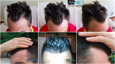 Norwood 2 Hair Transplantation Results | Asmed Hair Transplant