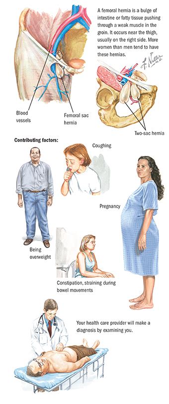 [DIAGRAM] Diagram Of Femoral Hernia - MYDIAGRAM.ONLINE