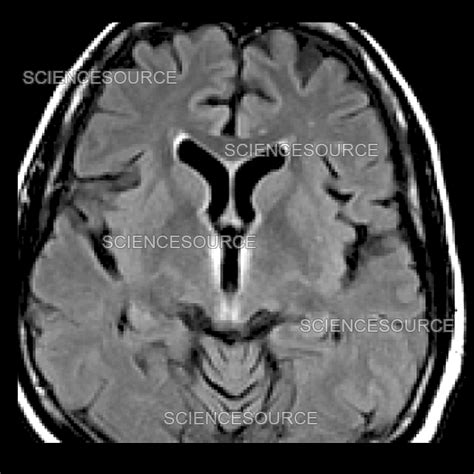 Wernicke's Encephalopathy, MRI | Stock Image - Science Source Images