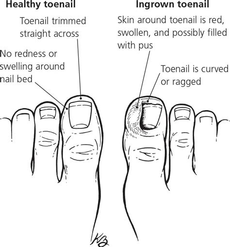 How To Get Toenails To Grow Straight In 2022 With Steps – Get Long Nails