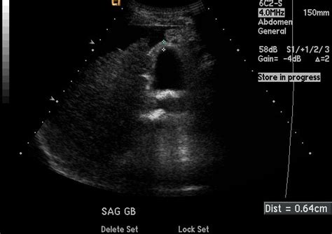 Gallbladder Wall Thickening – Differential Diagnosis | RADIOLOGYPICS.COM