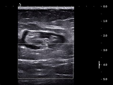 VIETNAMESE MEDIC ULTRASOUND: CASE 421: EPIGASTRIC HERNIA, Dr PHAN THANH HẢI, Dr DƯƠNG NGỌC THÀNH ...