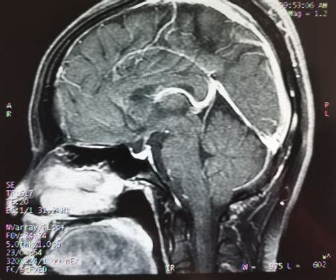 does this look like chiari? my mri report says low lying cerebellar tonsils believed to be part ...