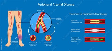 Peripheral artery disease ankle brachial index ABI test limb ischemia diagnosis vascular ABPI ...