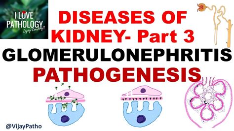 RENAL PATHOLOGY Part 3 : Glomerulonephritis- PATHOGENESIS - YouTube