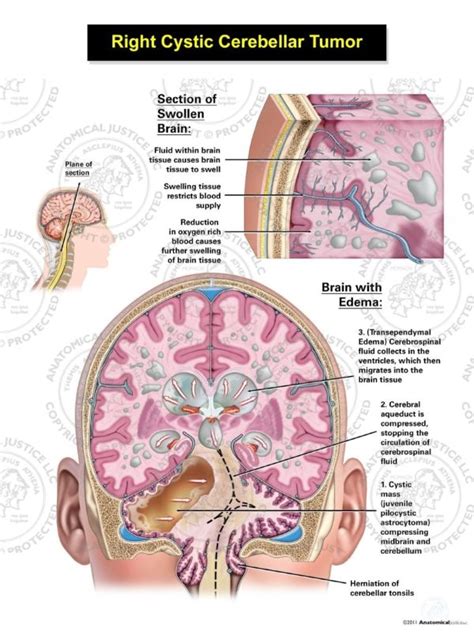 Right Cystic Cerebellar Tumor