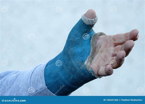 Broken arm. Arm in cast stock photo. Image of sling - 166441366