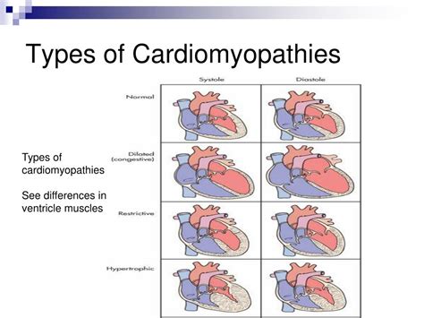 Types Of Cardiomyopathies