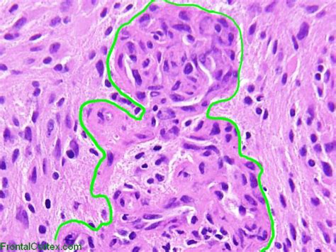 Glioblastoma multiforme, microvascular proliferation, H&E stain x 400 ...