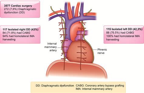 Diaphragm Dysfunction After Cardiac Surgery: Reappraisal - Journal of Cardiothoracic and ...