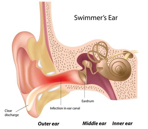 Swimmers Ear | Introduction, Symtoms & Treatment