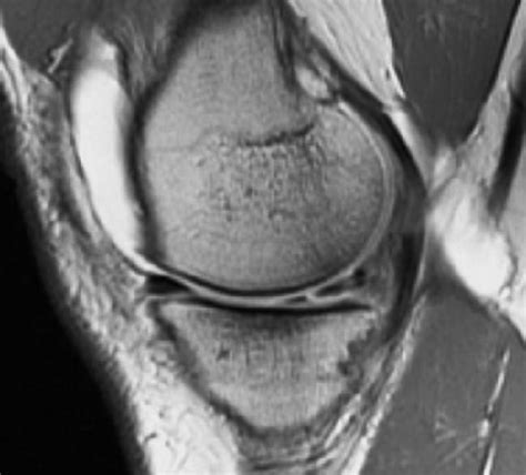 The Postoperative Meniscus | Radsource