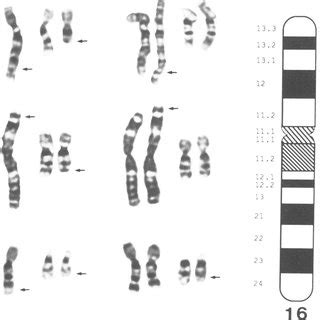 (PDF) Cystic fibrosis mutations delta F508 and G542X in Jewish patients