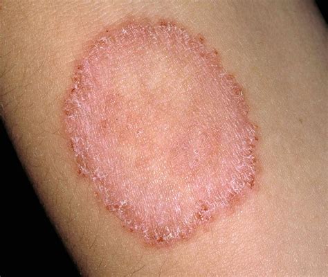 Ringworm Pictures, Types, Causes, and Treatment