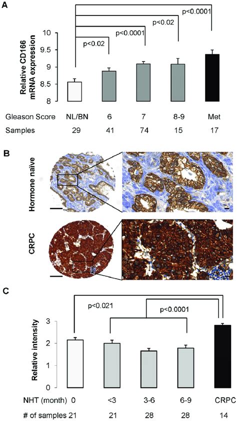 Gene expression profiling and tissue microarray (TMA) demonstrates that ...