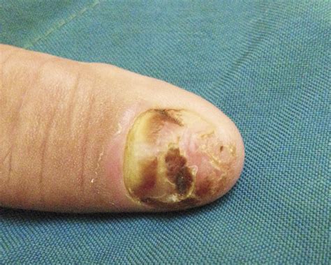 Squamous-Cell Carcinoma of the Nail Bed | NEJM