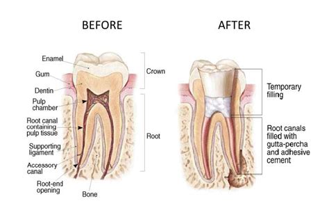 rct-before-after - Monroe Family Dentistry