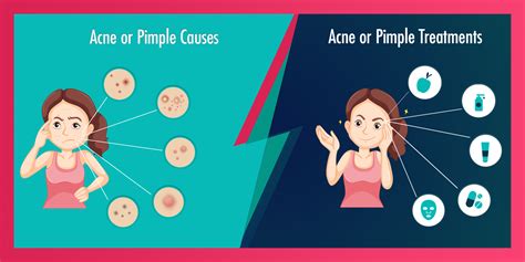 Acne or Pimple: Causes, Symptoms and Treatments