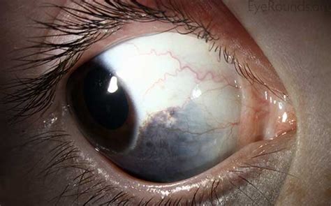 Oculodermal melanocytosis (nevus of Ota)