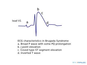 Brugada Syndrome - ECGpedia