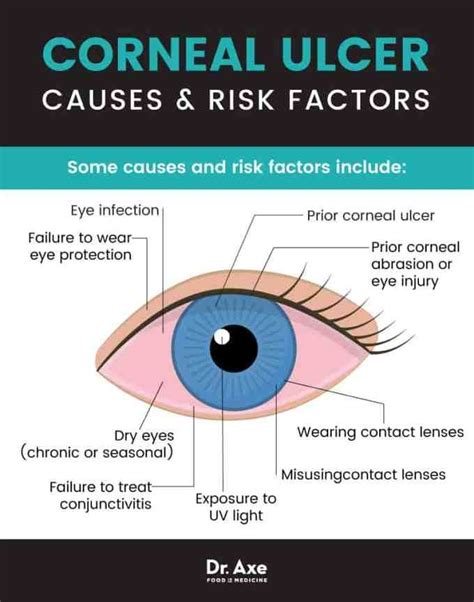 Corneal Ulcer Causes And Treatment Dry Eye Symptoms Dry Eye | My XXX Hot Girl