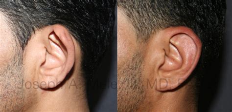 Otoplasty (Cosmetic Ear Surgery & Ear Pinning) SF Bay Area