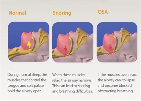 What Causes Very Loud Snoring – Top Snoring Devices