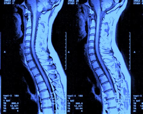 Osteophyte. Medical search